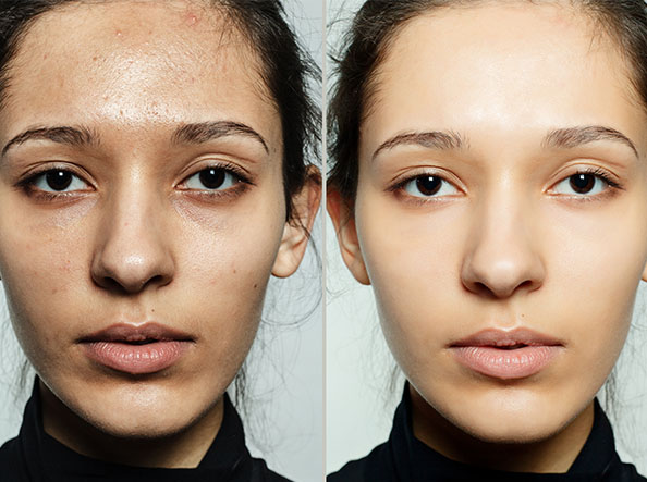 Chemical Peels