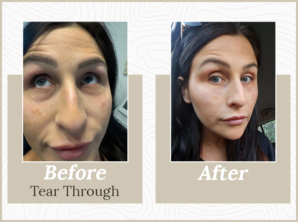 Dermal Fillers